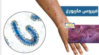 حالة استنفار صحي بإثيوبيا بعد اكتشاف فيروس “ماربورغ” القاتل